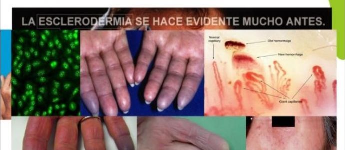 La Asociación Española de Esclerodermia y el COFCAM promueven una charla para la detección precoz de esta enfermedad rara